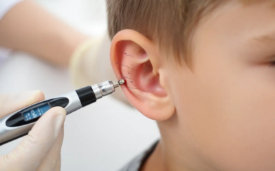 Acupuncture pour les enfants efficace avec le laser à Rennes
