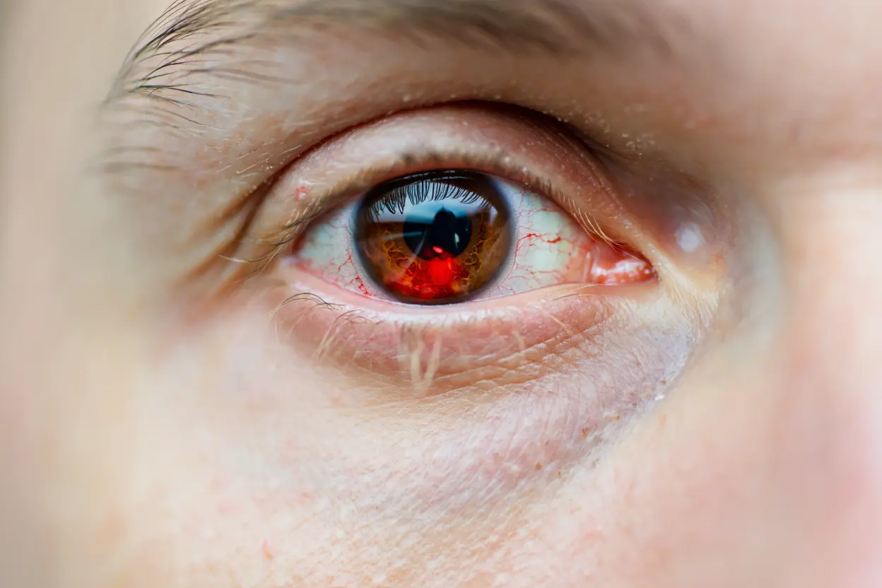 Acupuncture pour soigner les troubles de yeux et le glaucome à rennes